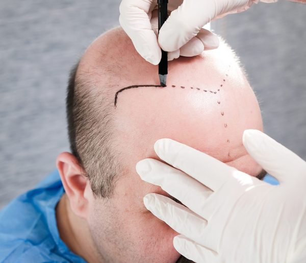 The,Doctor,Is,Planning,And,Marking,The,Patient's,Hairline,Before
