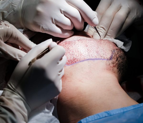 Beard,Transplant,Surgery,Close,Up,Photo.,Doctor,Is,Implanting,Hair